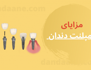 فواید و مزایای ایمپلنت دندان