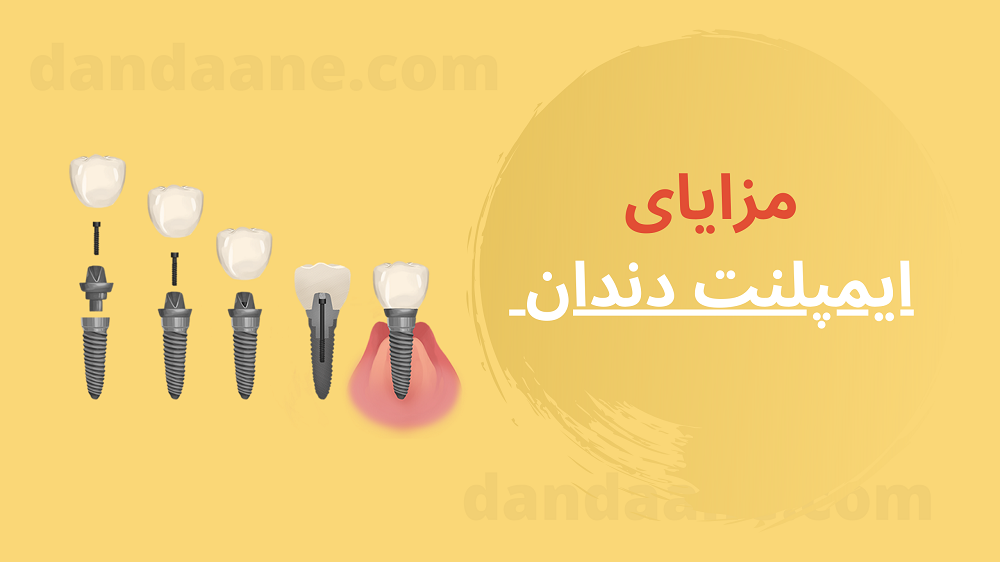 فواید و مزایای ایمپلنت دندان