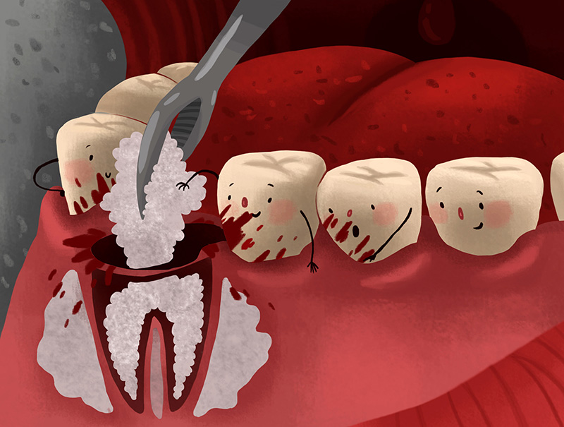 تصویر کارتونی پیوند استخوان قبل از کاشت ایمپلنت دندان