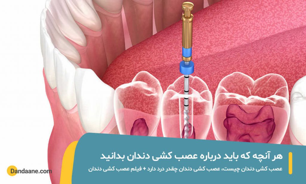 همه چیز درباره عصب کشی دندان