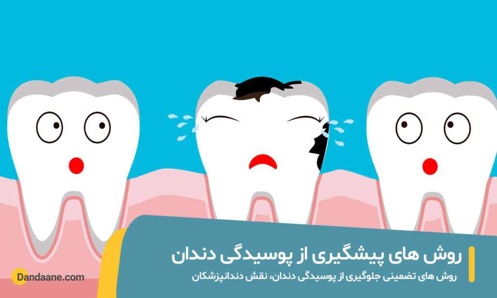 روش های پیشگیری از پوسیدگی دندان