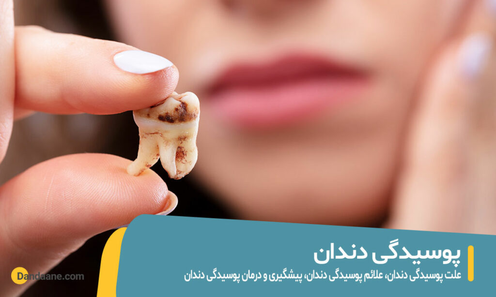 پوسیدگی دندان چیست و چه علائمی دارد