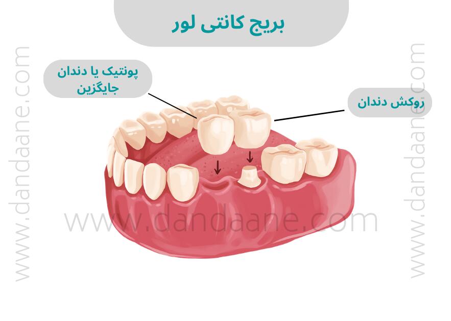 قیمت بریج دندان در سال 1401 (قیمت بریج کانتی لور)