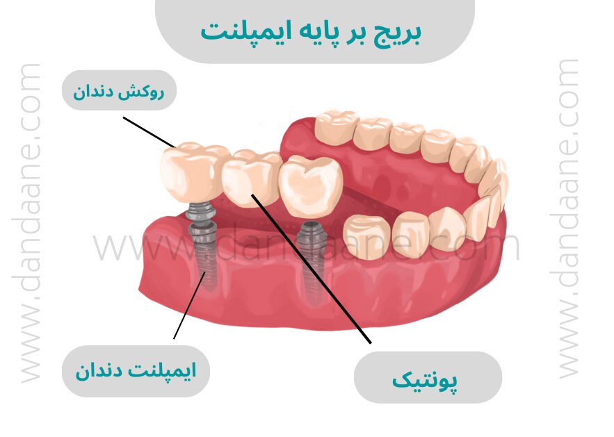 عکس بریج متکی بر ایمپلنت