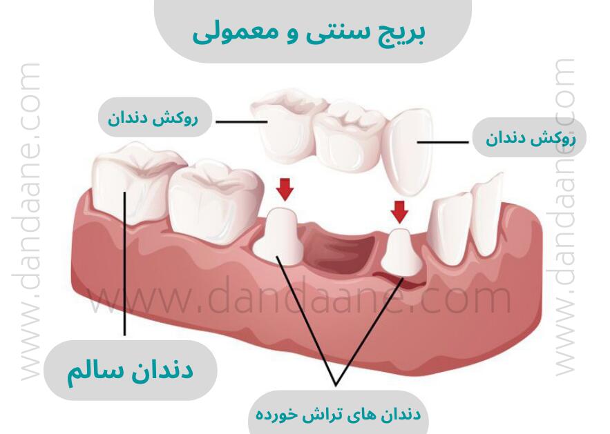 قیمت بریج دندان در سال 1401 - عکس بریج سنتی