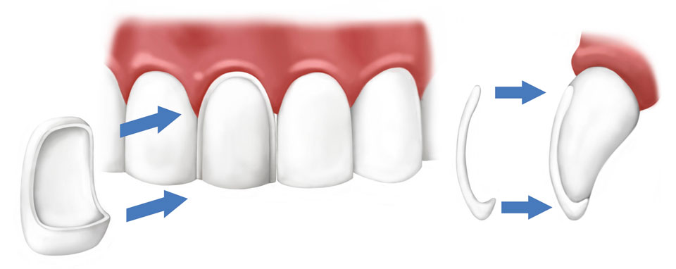 تصویر شماتیک لیمنت دندان
