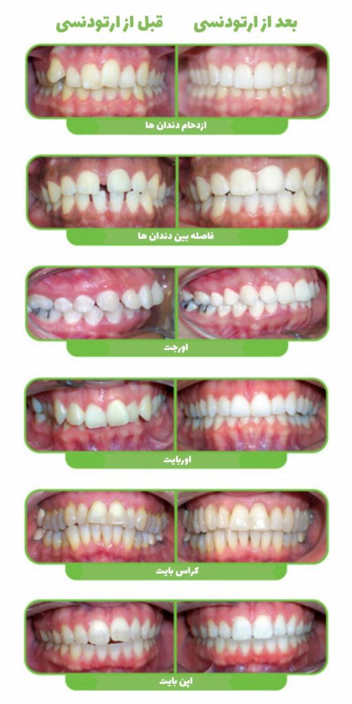 ارتودنسی دندان قبل و بعد