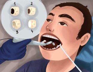 پر کردن دندان ها