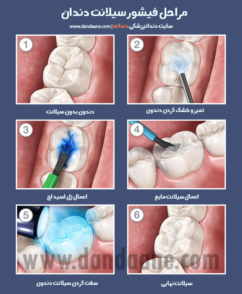 اینفوگرافی مراجل فیشور سیلانت دندان