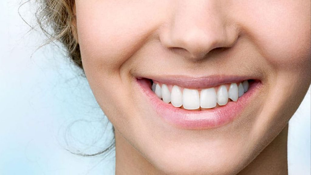 تصویر لبخند یک خانم که لمینت دندان انجام داده است.