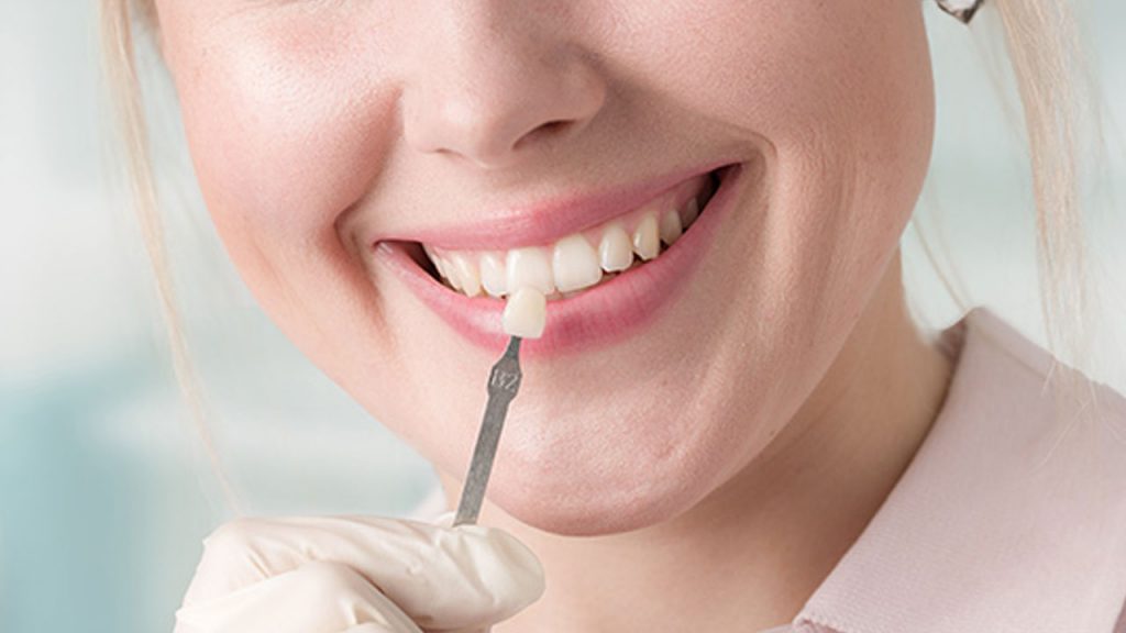 تصویر یک خانم که لمینت دندان را در جلوی دندان های خود نشان می دهد