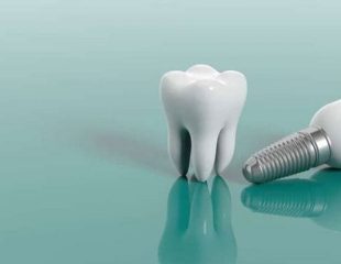 هزینه ایمپلنت دندان