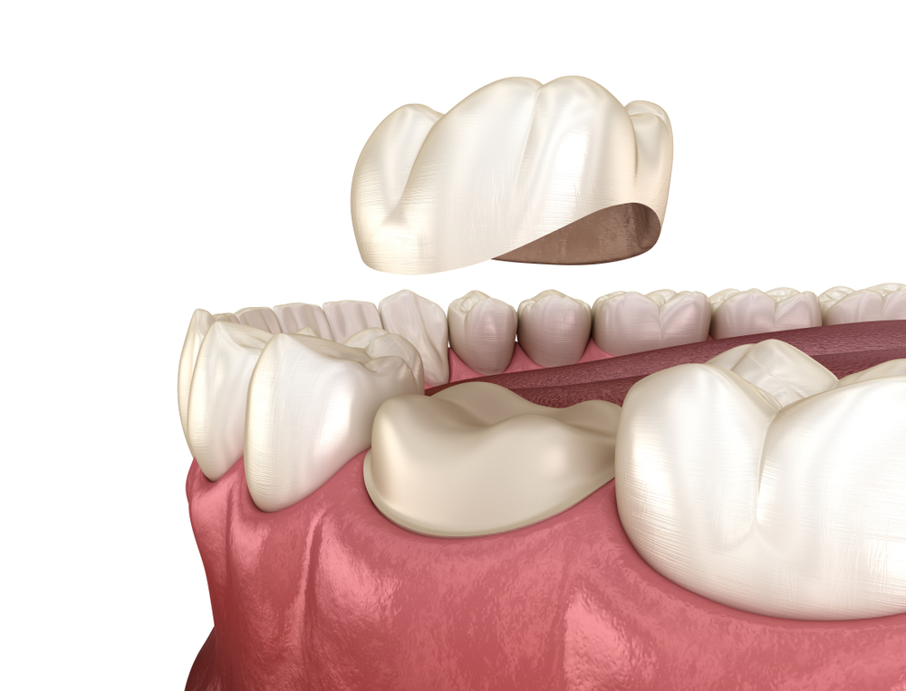 تصویر شماتیک تاج دندان