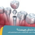 ایمپلنت دندان چیست؟