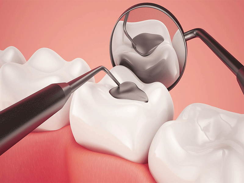 هزینه پرکردن دندان