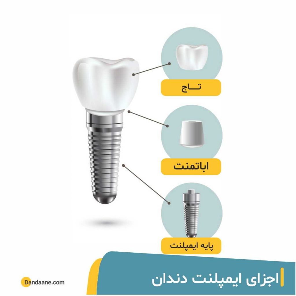 اینفوگرافی شامل اجزای ایمپلنت دندان