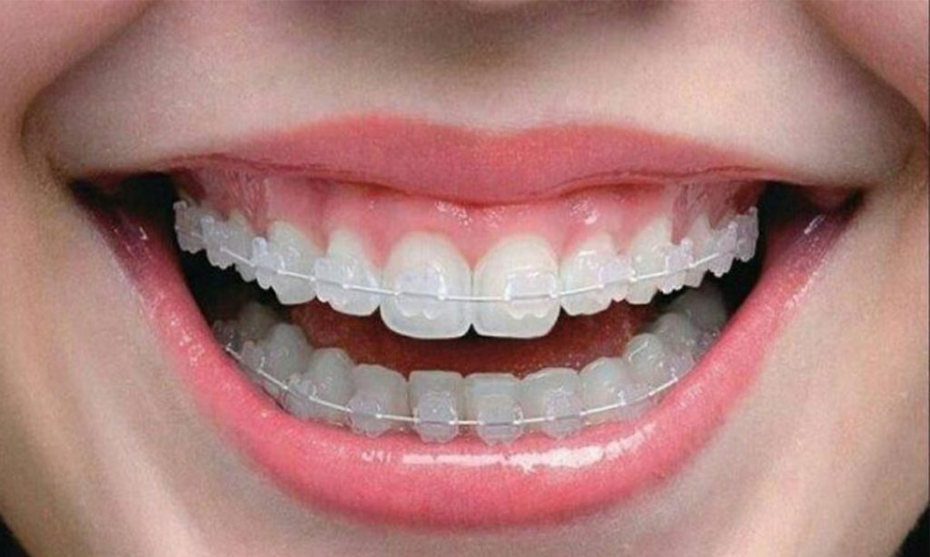 عکس ارتودنسی سرامیکی