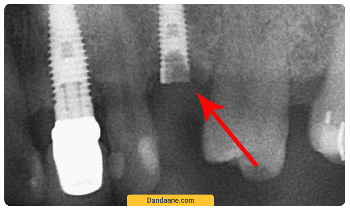 عکس ایمپلنت دندان ارزان و شکست خورده