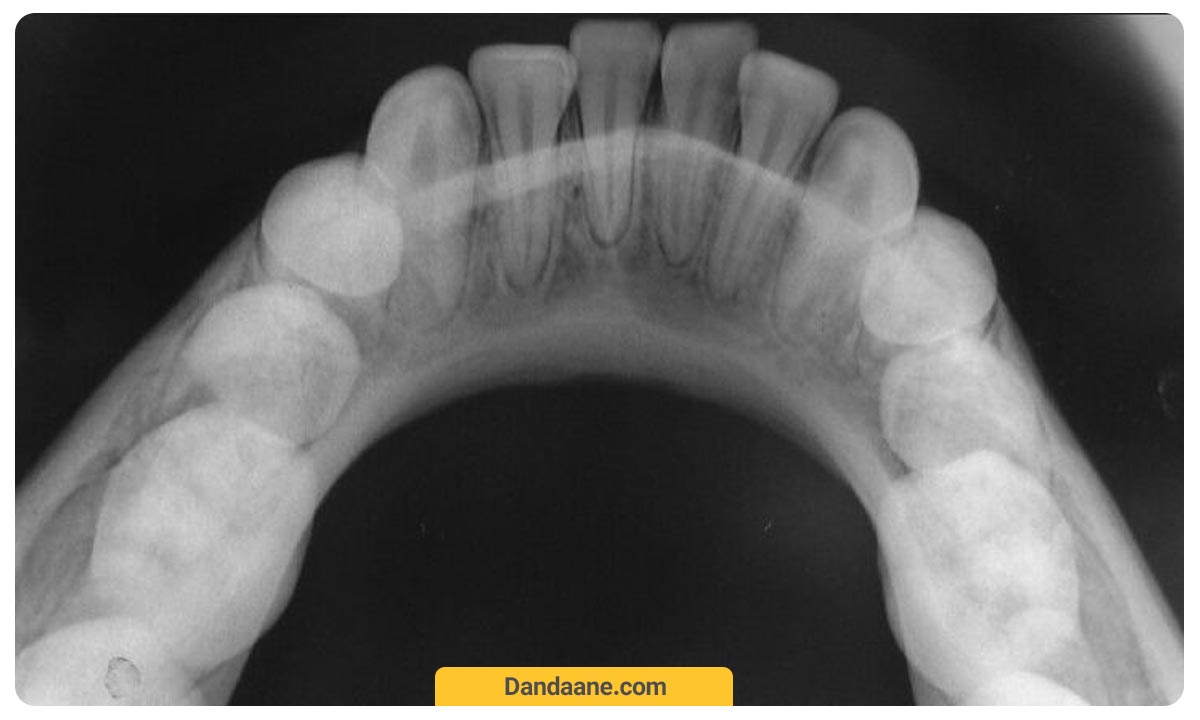 عکس دندان اکلوزال