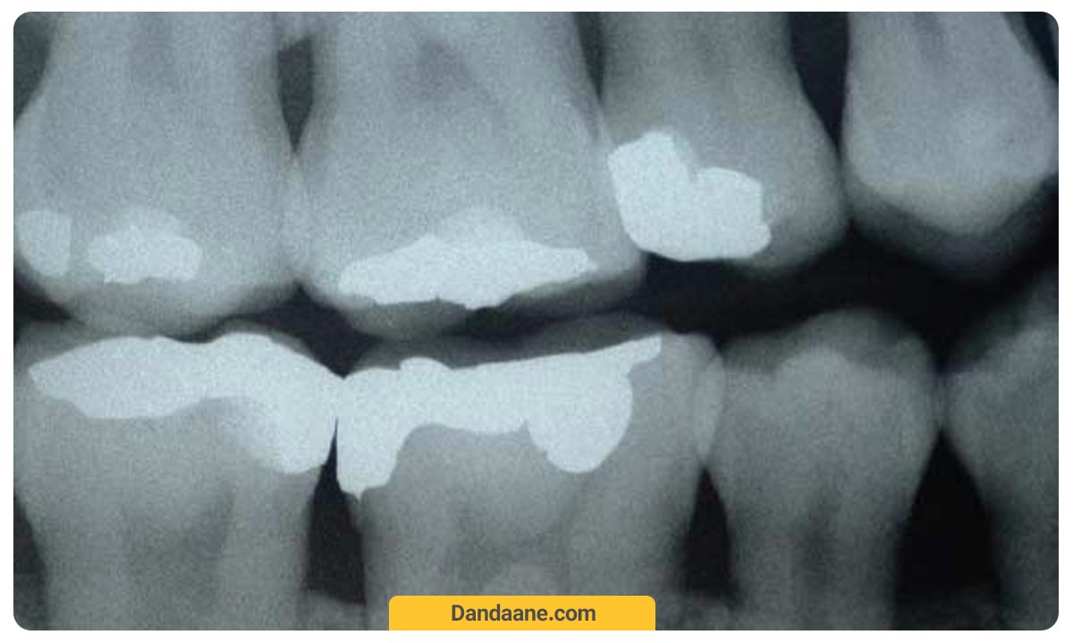 یک نمونه عکس دندان بایت وینگ که در ان دندان ها پر شده اند