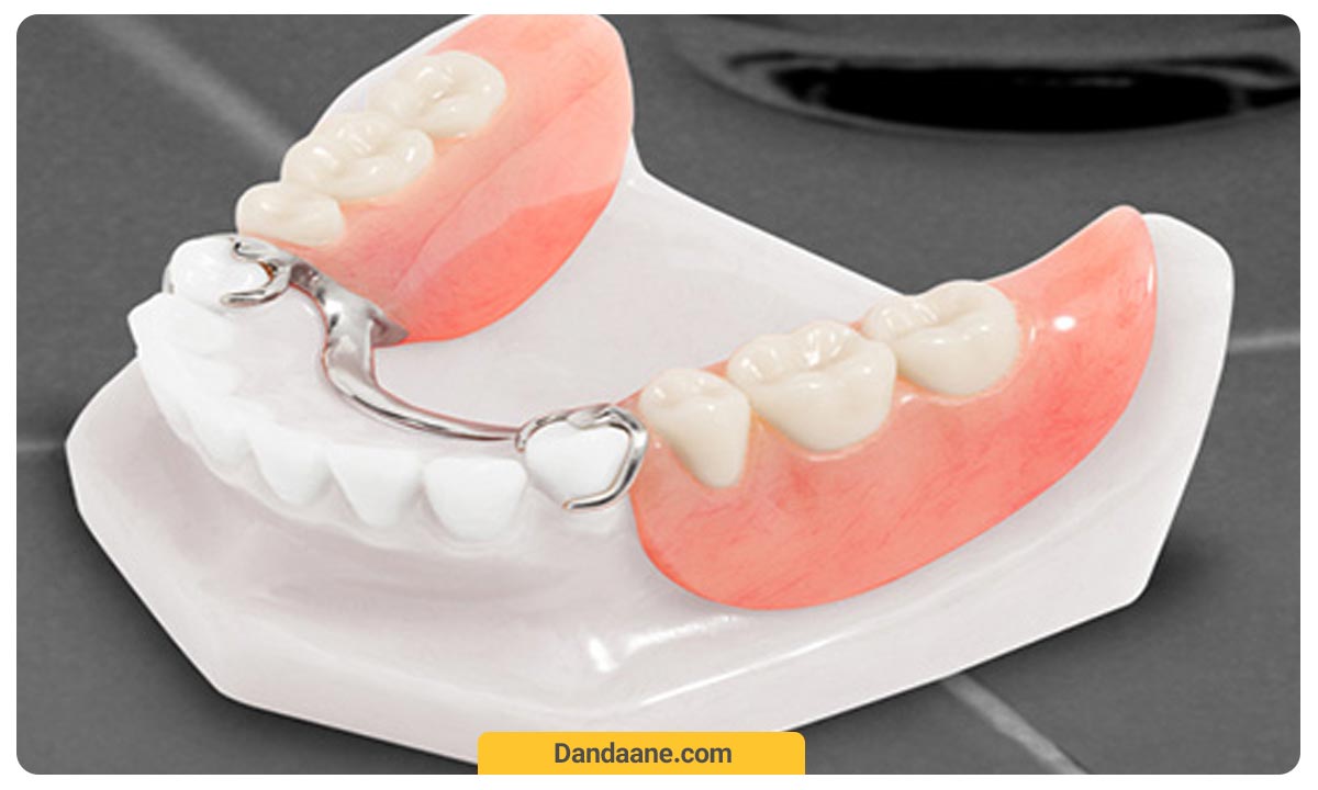 دندان مصنوعی پارسیل ترکیبی از فلز و پلاستیک برای یک فک
