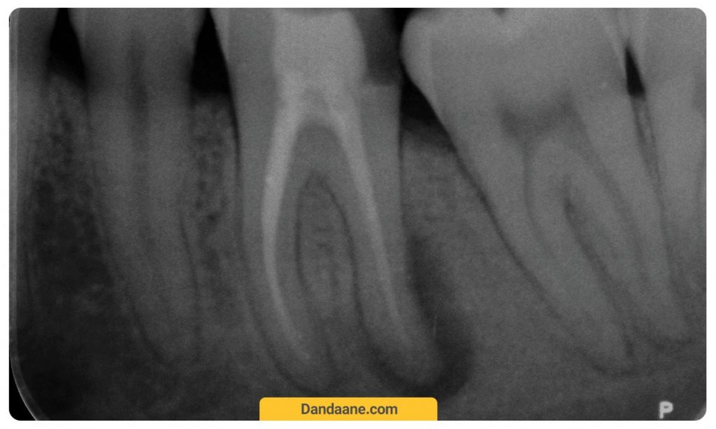یک نمونه از عکس دندان پری اپیکال