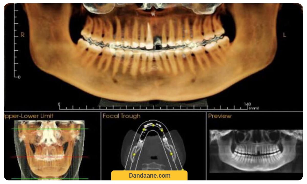 عکس دندان cbct