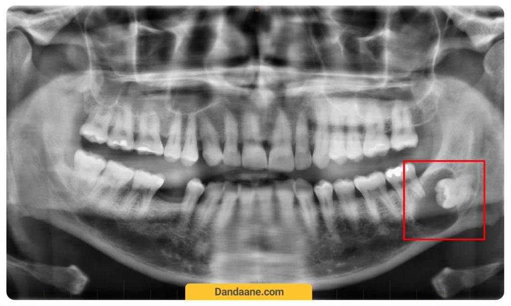 یک نمونه عکس دندان او پی جی