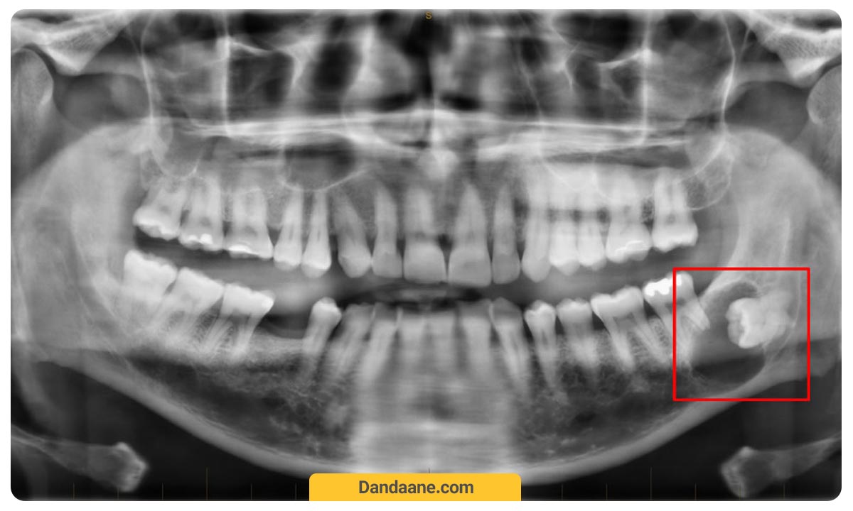 یک نمونه عکس دندان او پی جی