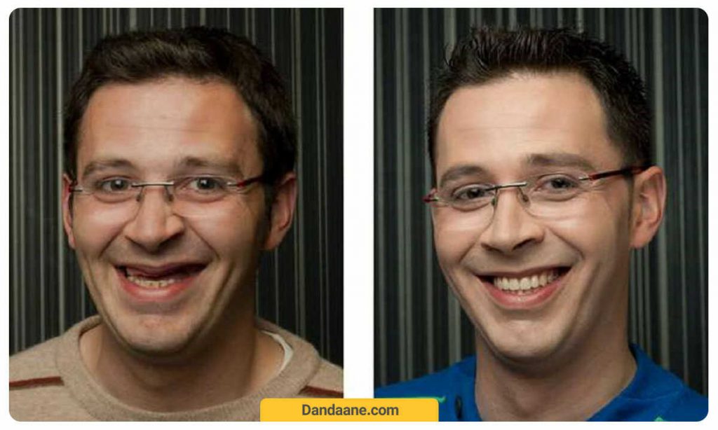 عکس ایمپلنت دندان قبل و بعد