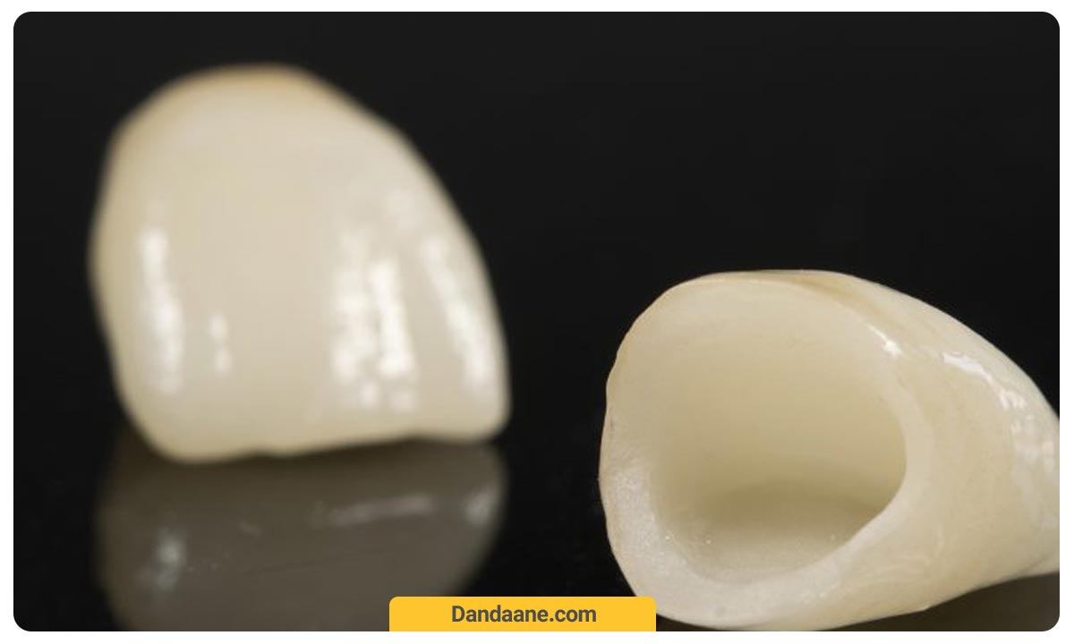 عکس روکش دندان سرامیکی که تماما از سرامیک ساخته شده است