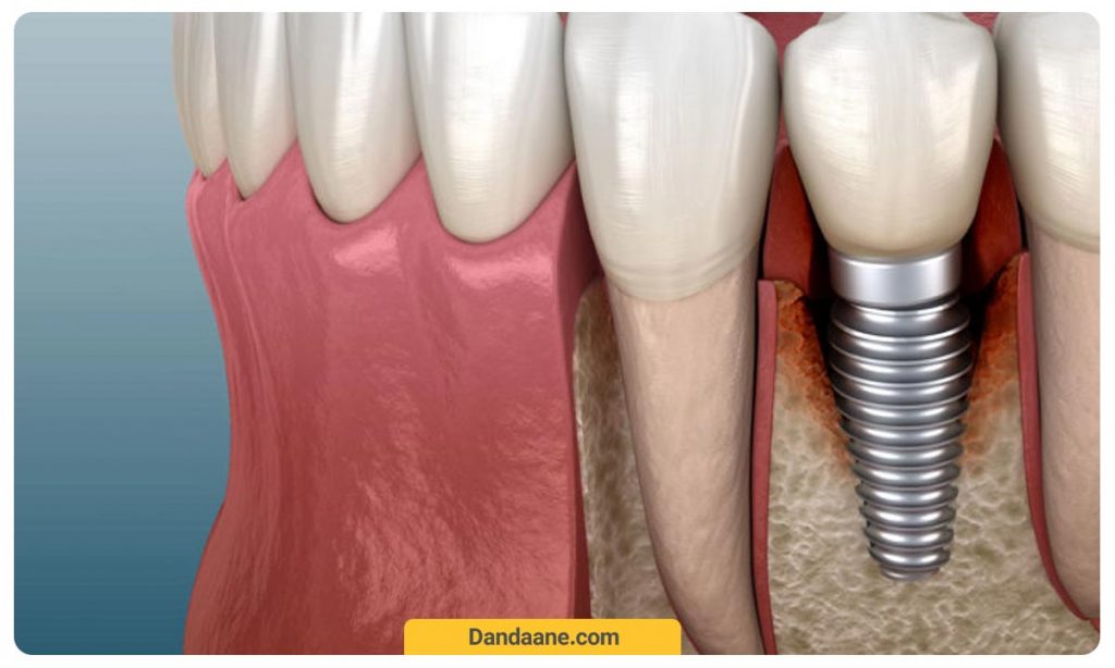 تصویر شماتیک ایمپلنت دندان