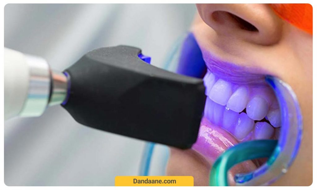 عکس بلیچینگ دندان در مطب با لیزر دیود
