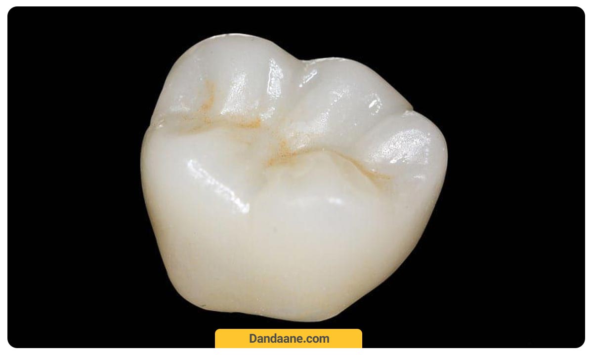 عکس روکش دندان زیرکونیا همراه با هزینه