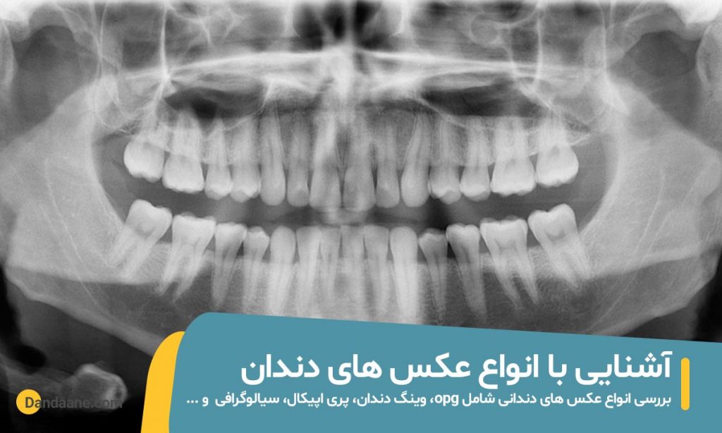 شاخص انواع عکس دندان (opg و ...)