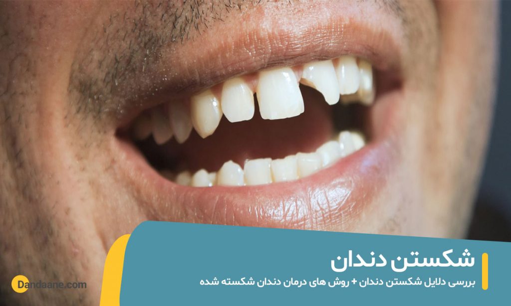 علت و درمان شکستن دندان