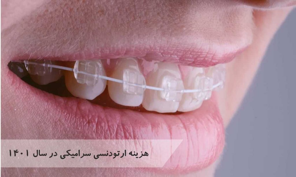 هزینه ارتودنسی سرامیکی در سال 1401 چقدر است