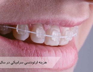 هزینه ارتودنسی سرامیکی در سال 1401 چقدر است