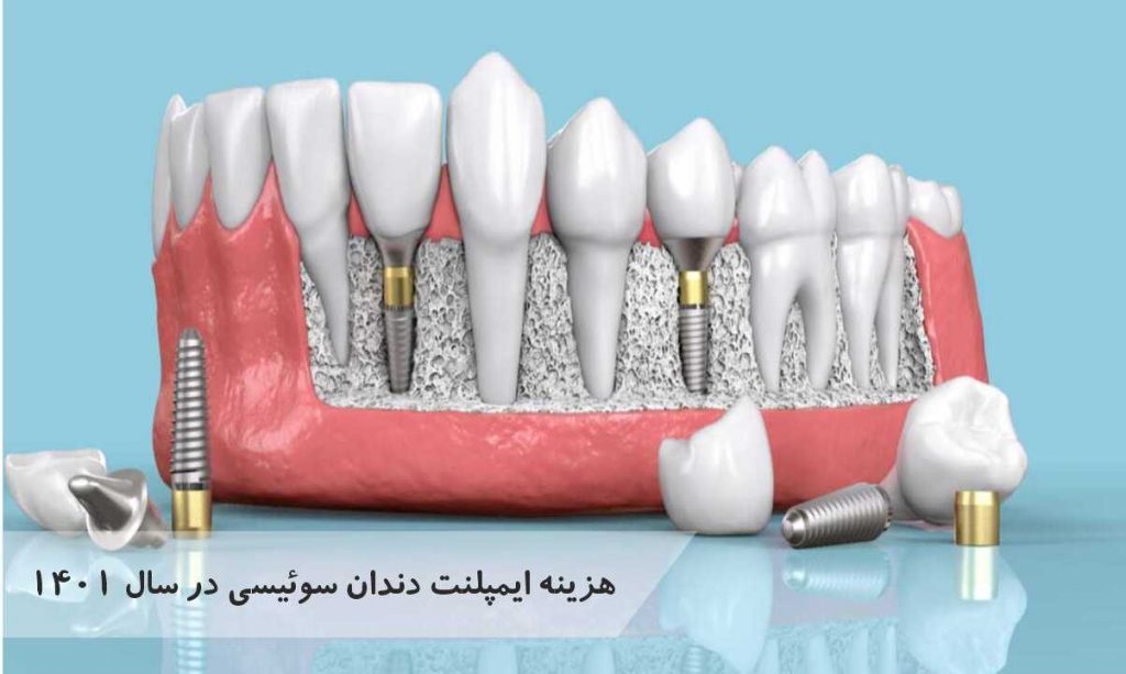 هزینه ایمپلنت دندان سوئیسی در سال 1401