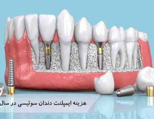 هزینه ایمپلنت دندان سوئیسی در سال 1401