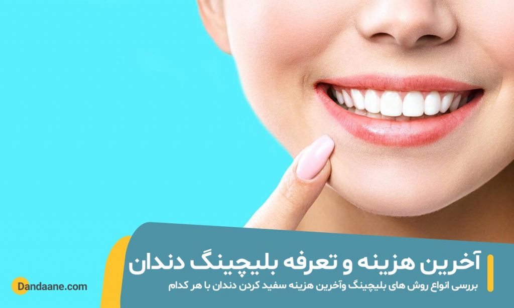 عکس نتایج بلیچینگ دندان در مطب