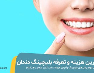 عکس نتایج بلیچینگ دندان در مطب