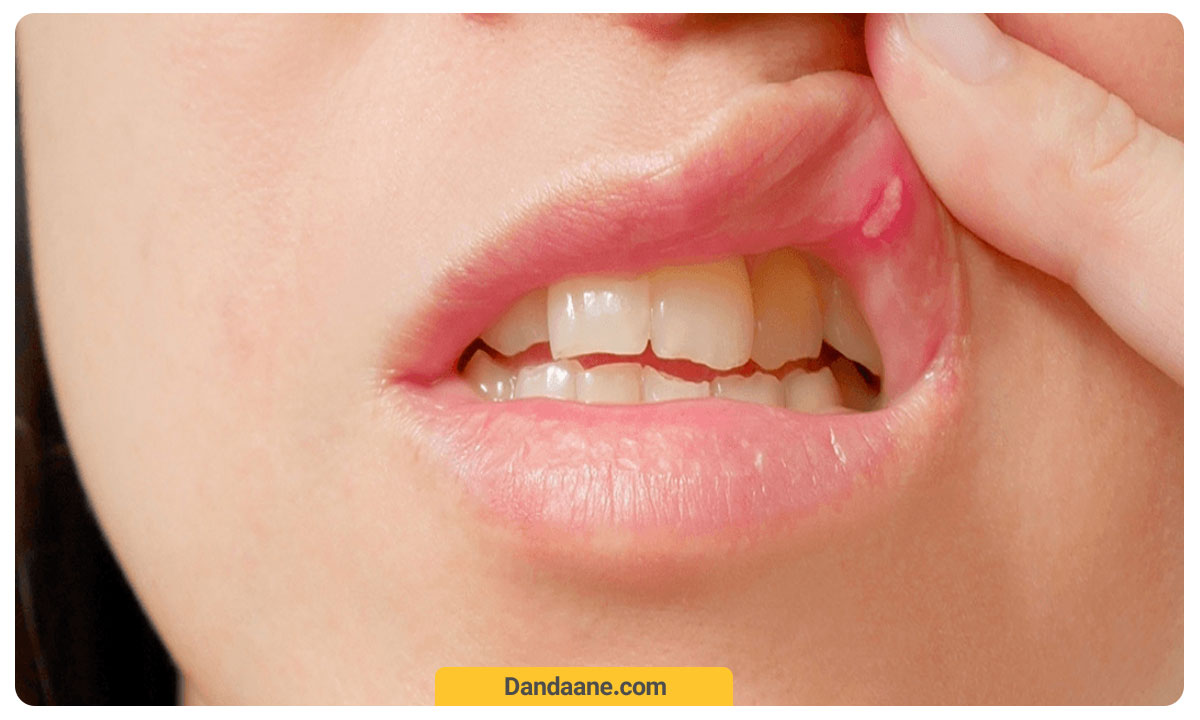یک آفت دهانی سفید رنگ در قسمت داخلی دهان