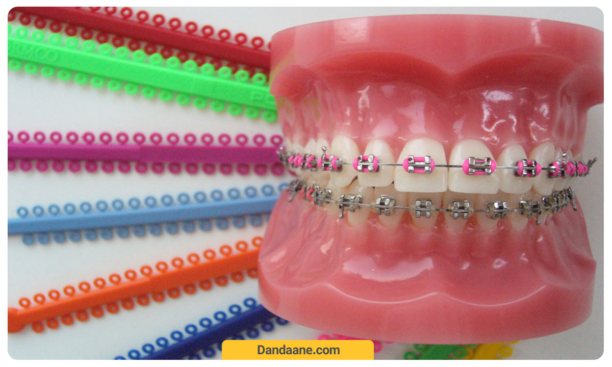 تصویر یک مولاژ دندانی با بریس ثابت که از کش های رنگی استفاده برای فیکس کردن سیم استفاده شده است. این یک حالت ارتودنسی رنگی است