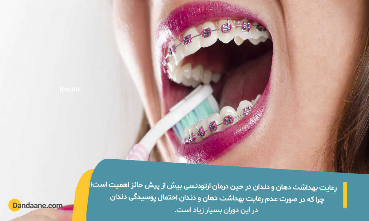 دلیل اهمیت رعایت بهداشت دهان و دندان در زمان ارتودنسی