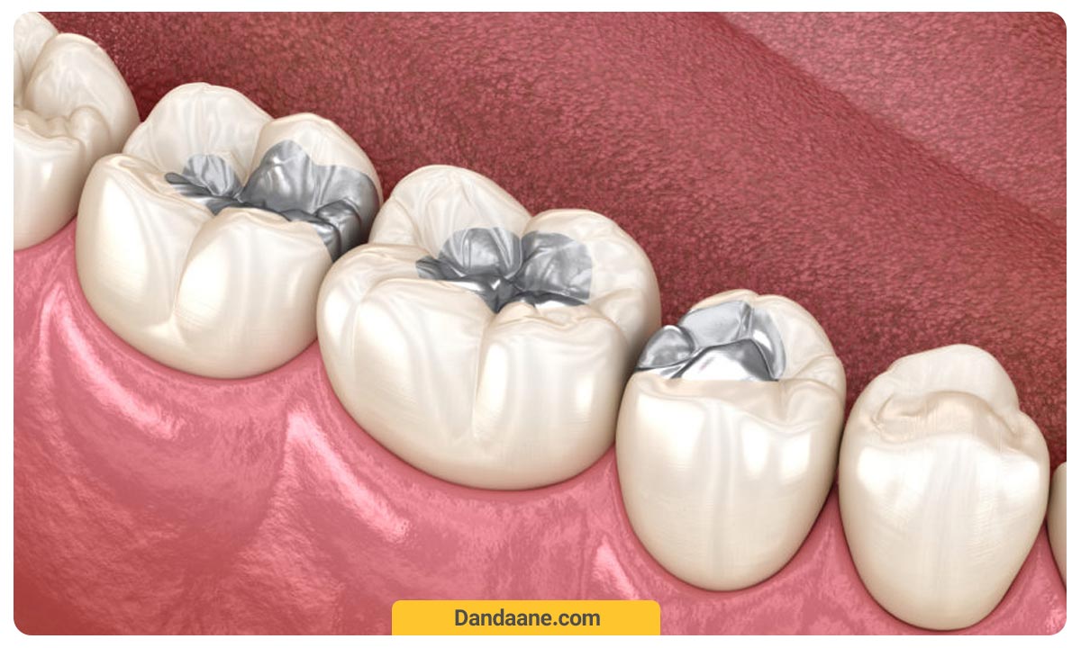 پر کردن قسمت های مختلف دندان پوسیده