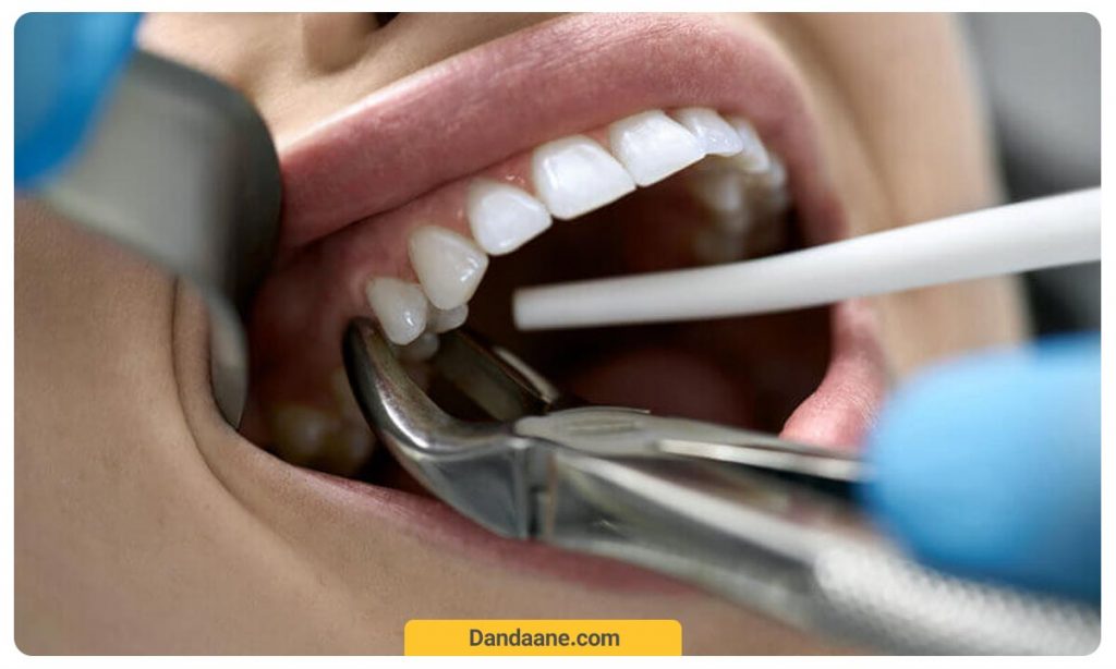 تصویری که کشیدن دندان آسیاب را نشان می دهد. هزینه کشیدن دندان آسیاب بیشتر از دندان های جلویی است