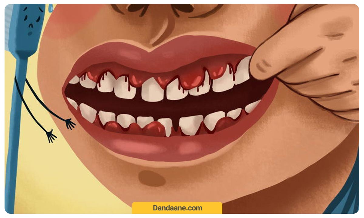 جرمگیری نکردن دندان چه عواقبی دارد