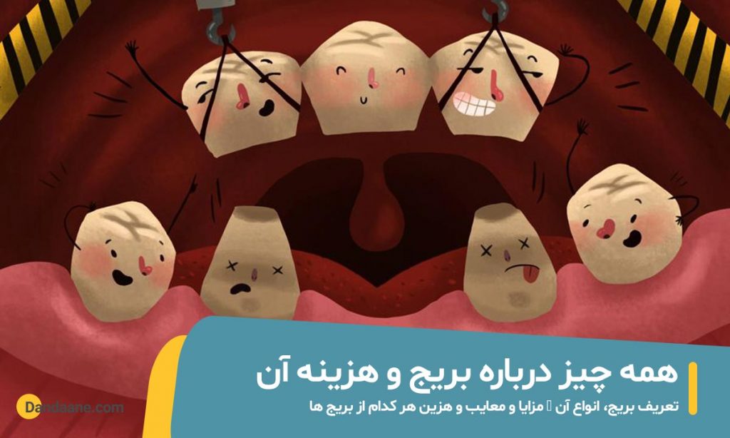 شاخص هزینه بریج دندان
