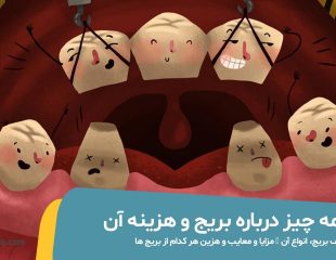 شاخص هزینه بریج دندان